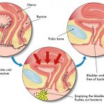 cistite_uroblog