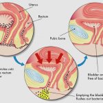 uroblog_cistite