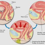 uroblog_cistite
