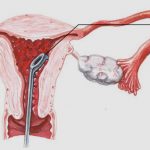 uroblog_fattore_uterino_2