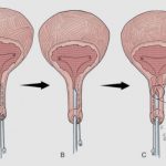 uroblog_incontinenza_urinaria_3