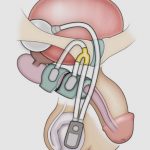 uroblog_incontinenza_urinaria_4