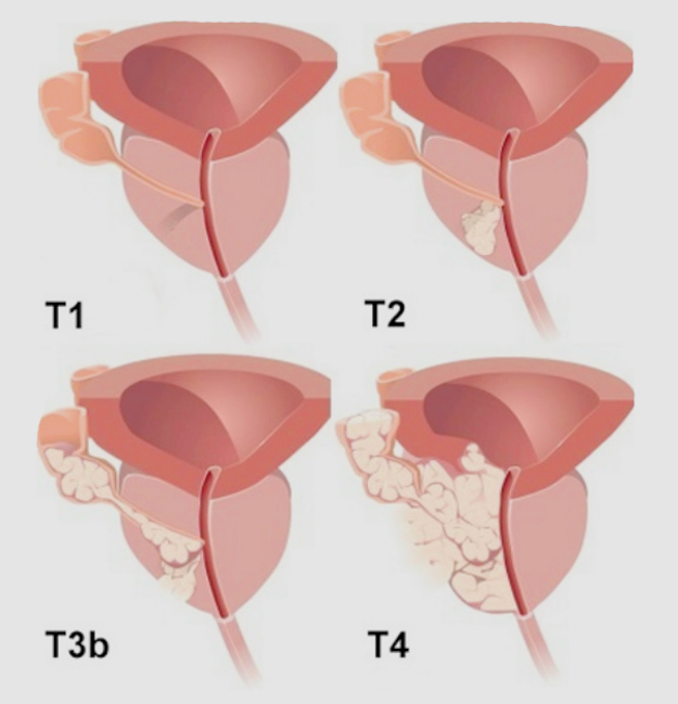 uroblog_tumore_prostata