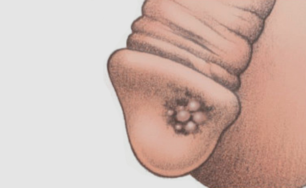 papilloma virus e tumore del pene