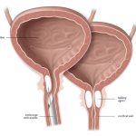 Uroblog_INCONTINENZA