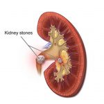 uroblog_calcolosi_