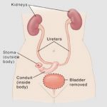 uroblog_cacciamani_2