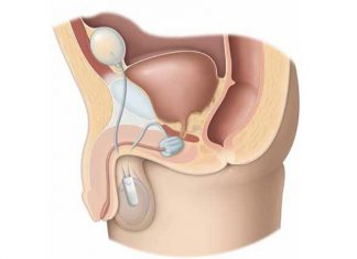 Incontinenza urinaria post-chirurgica (Sfintere Artificiale)