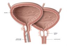 Incontinenza urinaria post-chirurgica