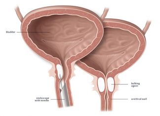 Incontinenza urinaria post-chirurgica