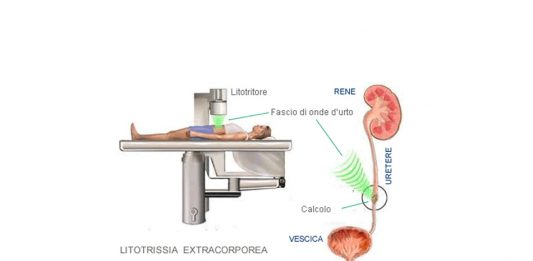 “Bombardamento”: la litotrissia extracorporea