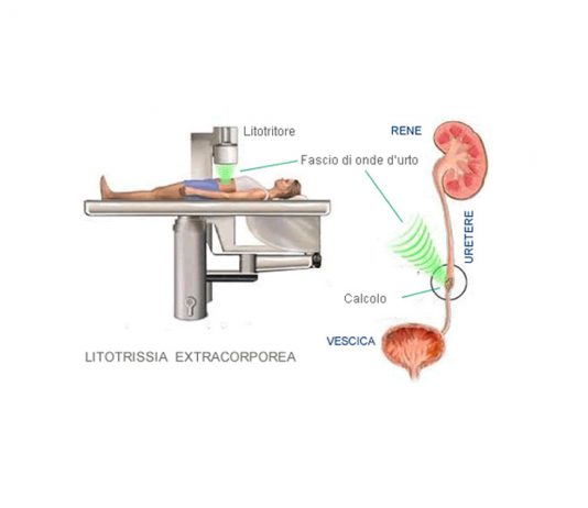 “Bombardamento”: la litotrissia extracorporea