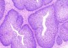 Papilloma virus ed infezione sessualmente trasmesse nell’uomo.