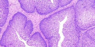 Papilloma virus ed infezione sessualmente trasmesse nell’uomo.