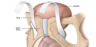 Incontinenza urinaria post-chirurgica (Sling)