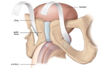 Incontinenza urinaria post-chirurgica (Sling)