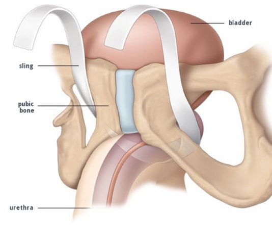 Incontinenza urinaria post-chirurgica (Sling)