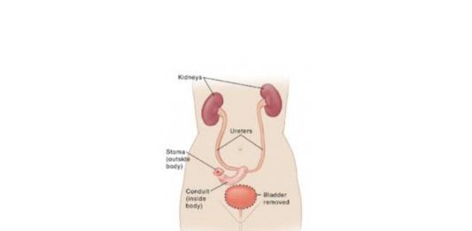 Qualità di vita nei pazienti sottoposti a….