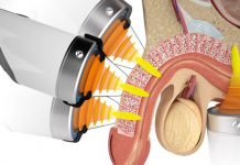 Trattamento della malattia di Peyronie con terapia ad onde d’urto (ESWT): quali sono le evidenze scientifiche?