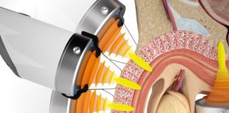 Trattamento della malattia di Peyronie con terapia ad onde d’urto (ESWT): quali sono le evidenze scientifiche?
