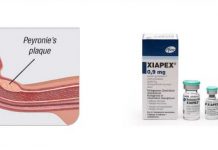 Efficacia e Sicurezza del protocollo con Collagenasi per il pene curvo da malattia di Peyronie Efficacia e Sicurezza del protocollo con Collagenasi di Clostridium histolyticum (CCH) per il pene curvo da malattia di Peyronie o Induratio Penis Plastica (IPP)