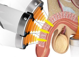 ESWT (onde d’urto peniene) – che correlazione c’è con il recupero dell’erezione?