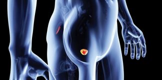 Efficacia delle onde d’urto nella cura di prostatite e dolore pelvico cronico